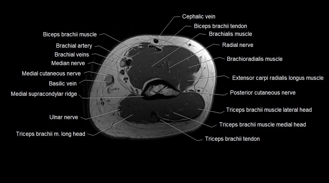 Upper arm( humerus) cross section anatomy MRI 3T axial image 49.webp